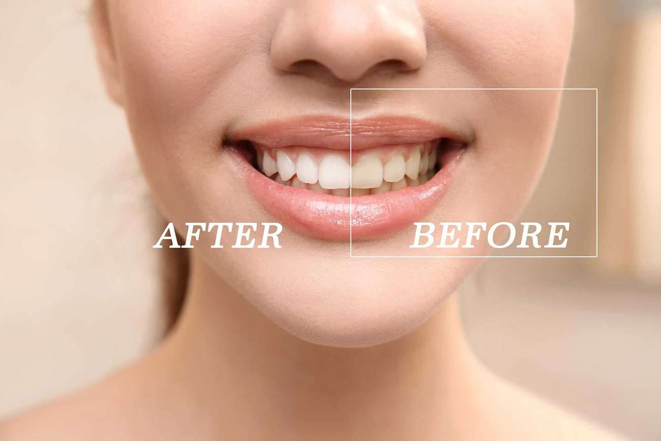 How Can You Maintain a Consistent Smile Shade with Crowns Bedford?