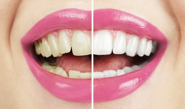 What Makes Ultima White Teeth Whitening Different Bedford