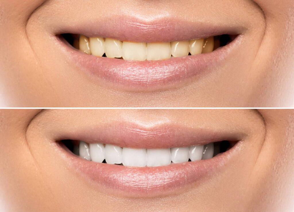 How Does Gum Disease Progress if Left Untreated Bedford?