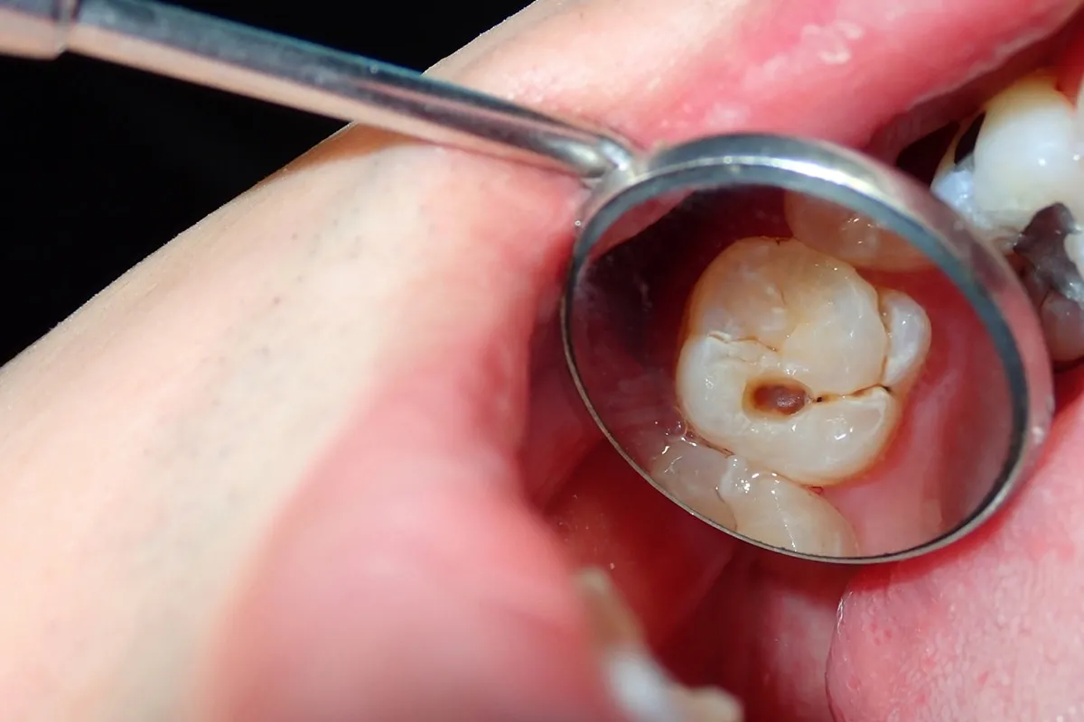 Why Do Teeth Crack? Common Causes to Know Bedford