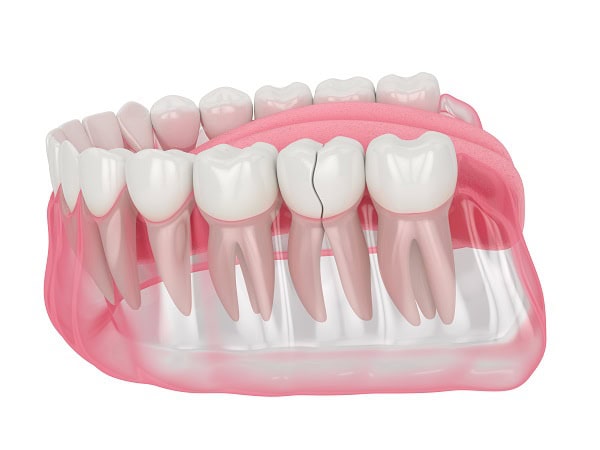 How Can You Manage Pain and Discomfort After a Root Canal Bedford?