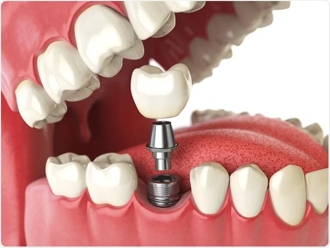 How Do I Decide Which Tooth Replacement Is Right for Me Bedford?