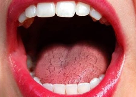 Common Causes of Dry Mouth (Xerostomia) Bedford