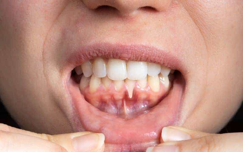 How Can Gum Disease Be Prevented Bedford?