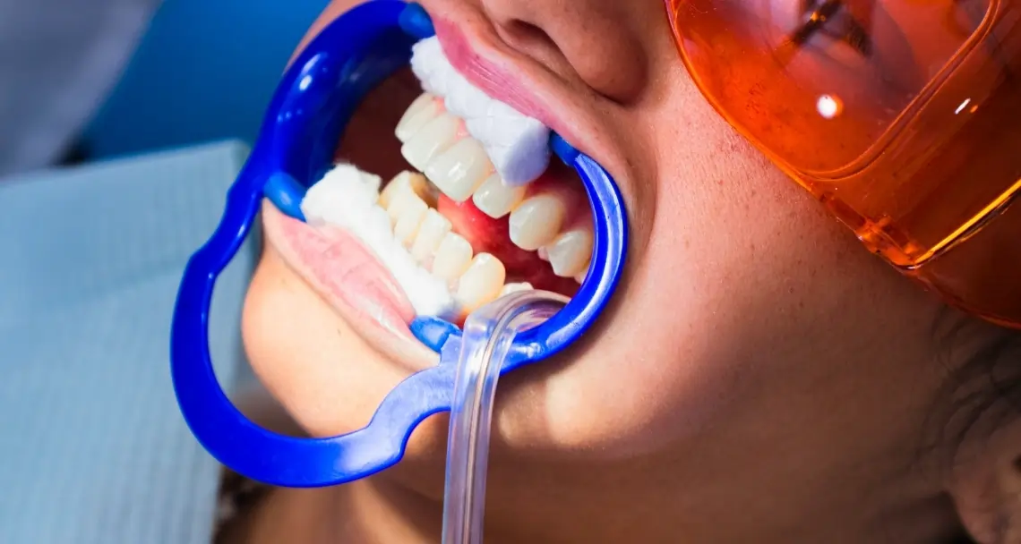 What Side Effects Can You Experience After Laser Teeth Whitening Bedford?