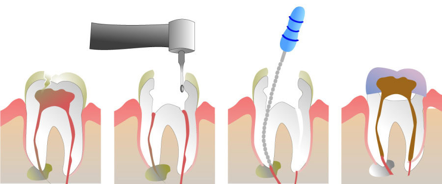 How Do You Properly Care for Your Teeth After a Root Canal Bedford