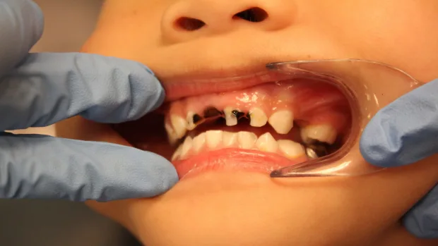 Which Foods and Drinks Cause the Most Damage to Young Smiles Bedford?