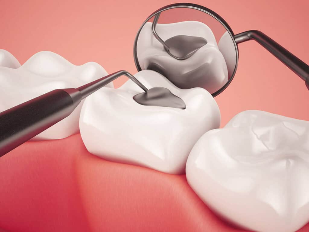 Fighting Cavities and Plaque Buildup Bedford