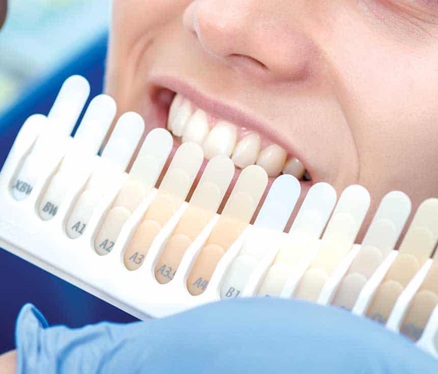 Professional vs At-Home Whitening: What You Need to Know Bedford