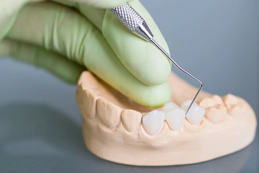 Do Braces Take Years to Show Results Bedford