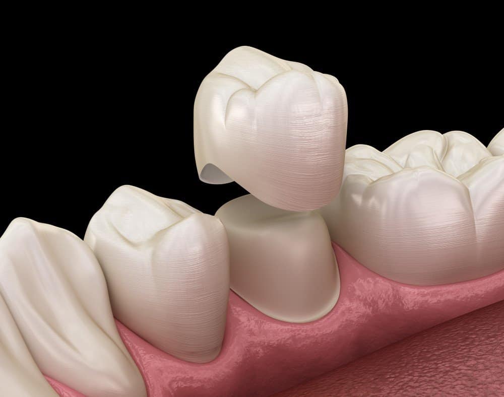 Teeth Whitening: Separating Facts from Fiction Bedford
