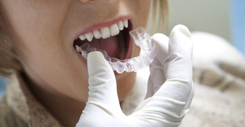 Why Bleaching Trays Require More Time Bedford